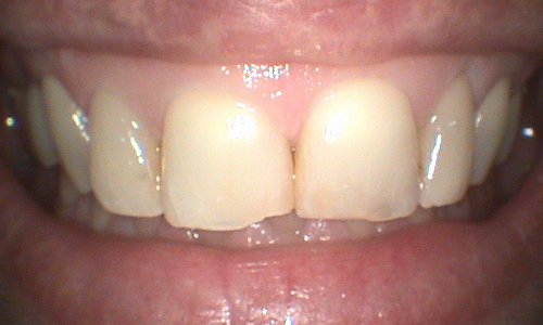 Before full mouth reconstruction in Hampstead - 46 year old lady