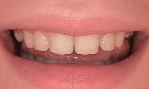 Before full mouth reconstruction in Hampstead - 18 year old lady