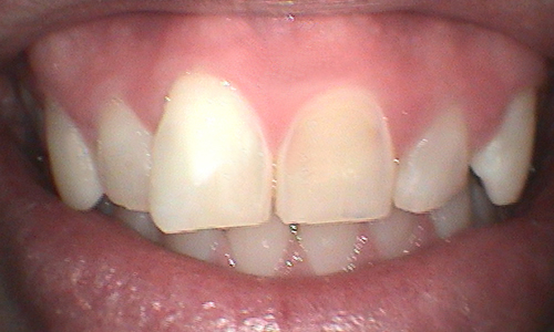 Before full mouth reconstruction in Hampstead - 38 year old man 