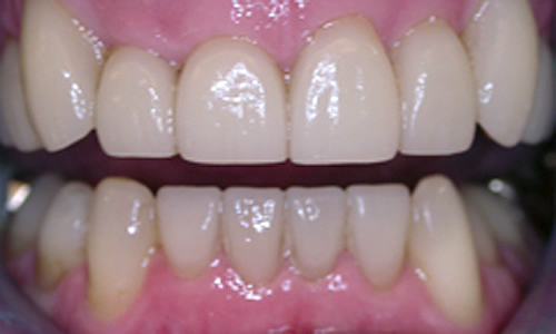 After Veneers used to improve alignment