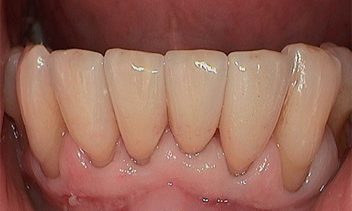After veneer treatment in Hampstead - 64 year old man