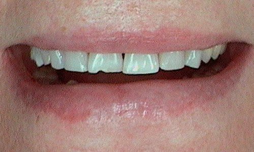 Before Chipped front teeth restored with Veneers