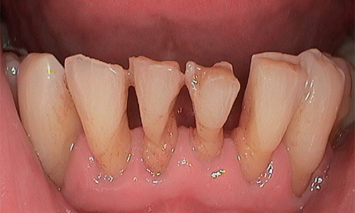 Before veneer treatment in Hampstead - 64 year old man