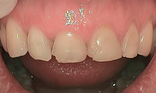 Before Cracked front teeth restored with Veneers