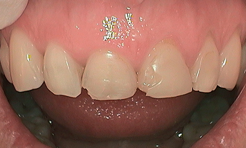 Before veneer treatment in Hampstead - 46 year old lady