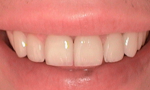 After Veneers used to improve spacing