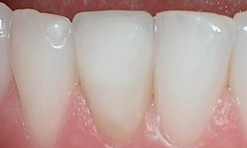 After veneer treatment in Harley Street - 47 year old man