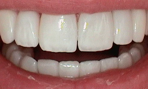 After veneer treatment in Harley Street - 47 year old man