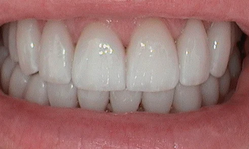 After veneer treatment in Harley Street - 47 year old man
