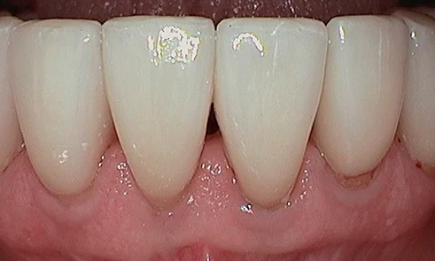 After veneer treatment in Harley Street - 47 year old man