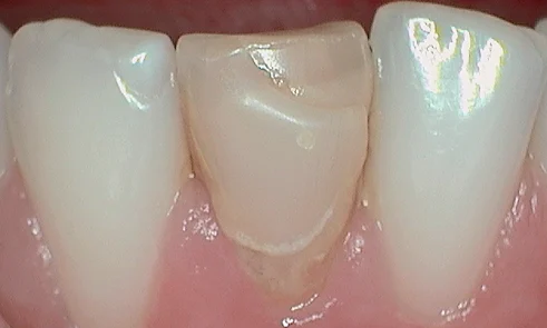 Before veneer treatment in Harley Street - 47 year old man