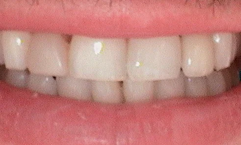 Before veneer treatment in Harley Street - 47 year old man