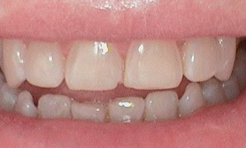 Before veneer treatment in Harley Street - 47 year old man