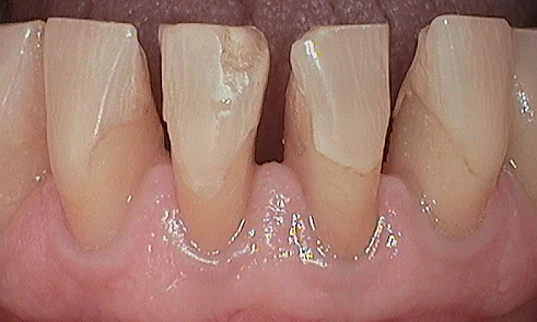 Before veneer treatment in Harley Street - 47 year old man