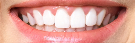 After Polanigt Teeth Whitening in London UK