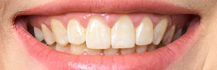 Before Teeth Whitening